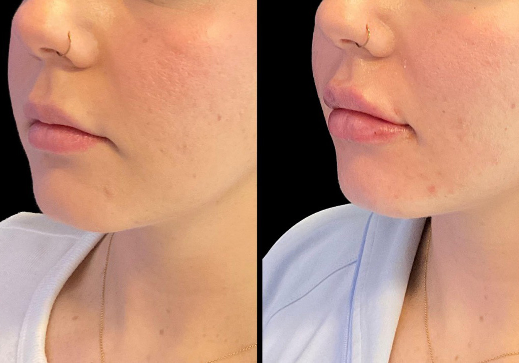 thumbnail_Injectables_female_Before_and_After-3.jpg