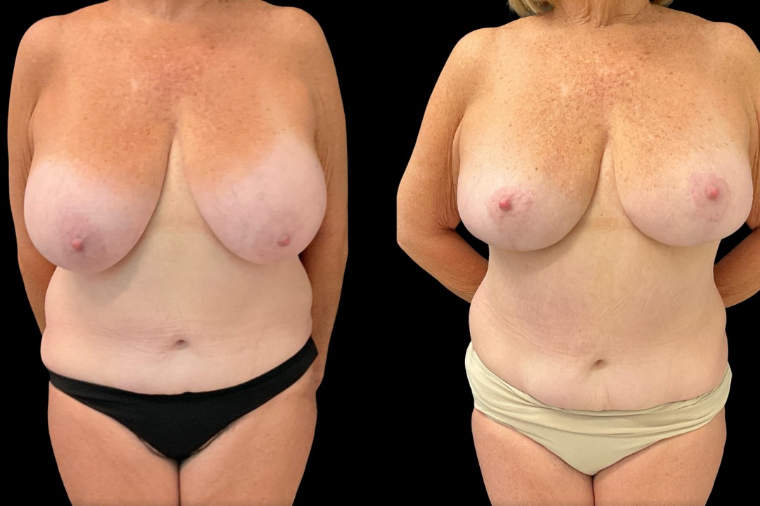 Breast reduction_female_before&after – 1