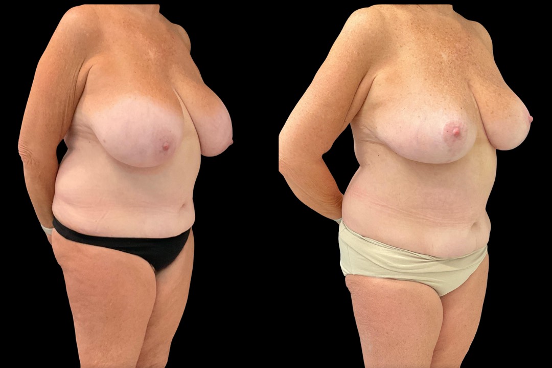 Breast reduction_female_before&after – 2