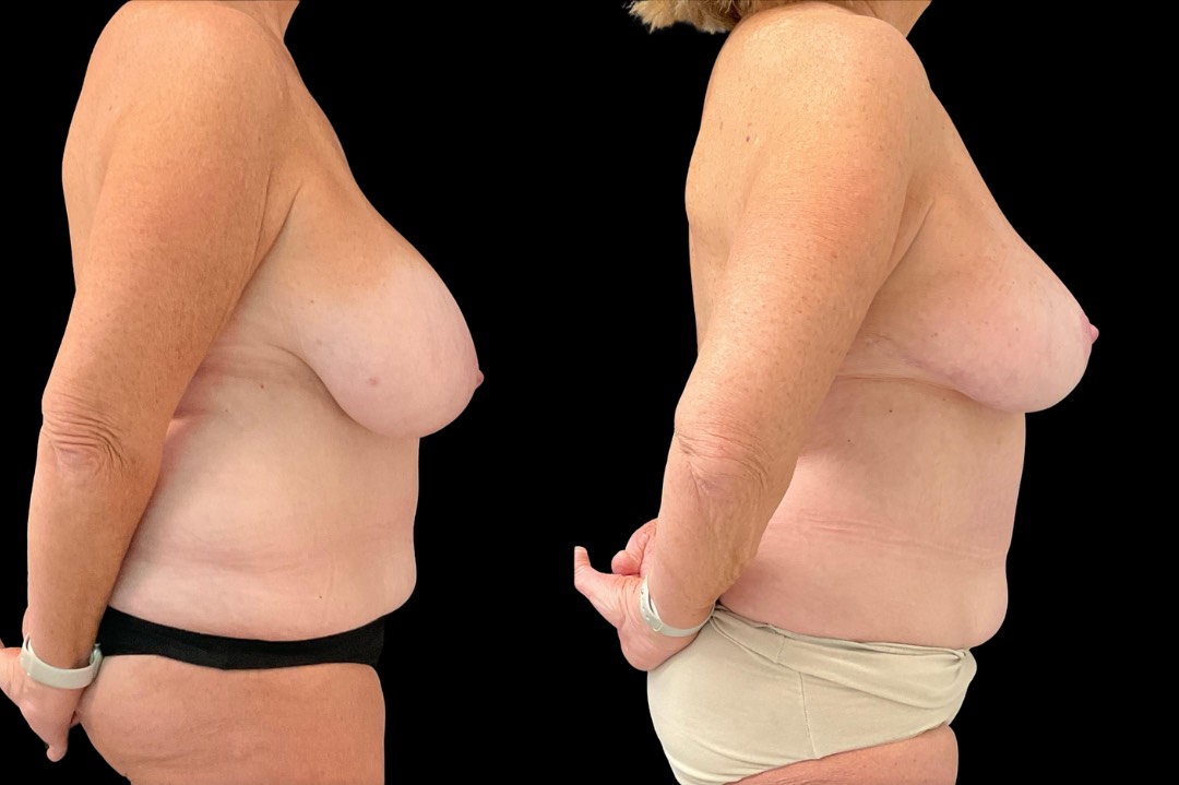 Breast reduction_female_before&after – 3