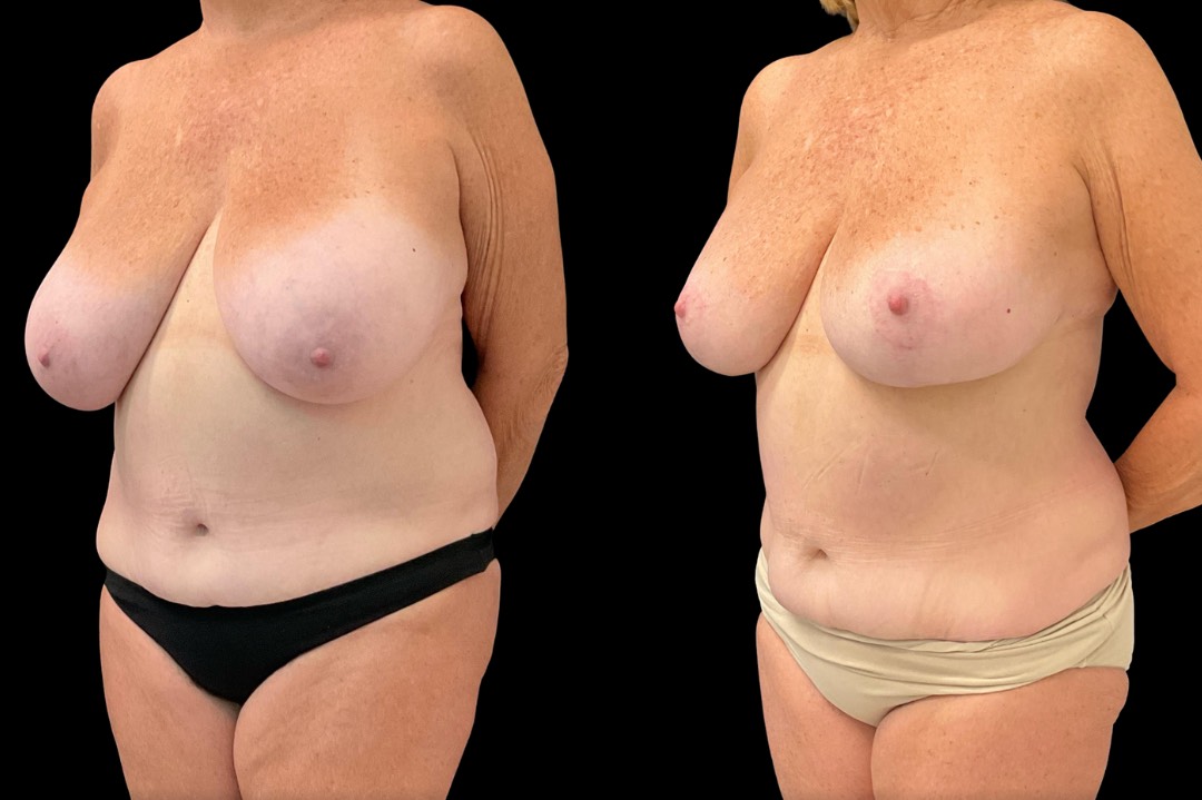 Breast reduction_female_before&after – 4