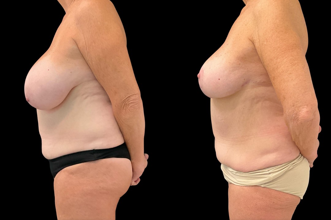 Breast reduction_female_before&after – 5