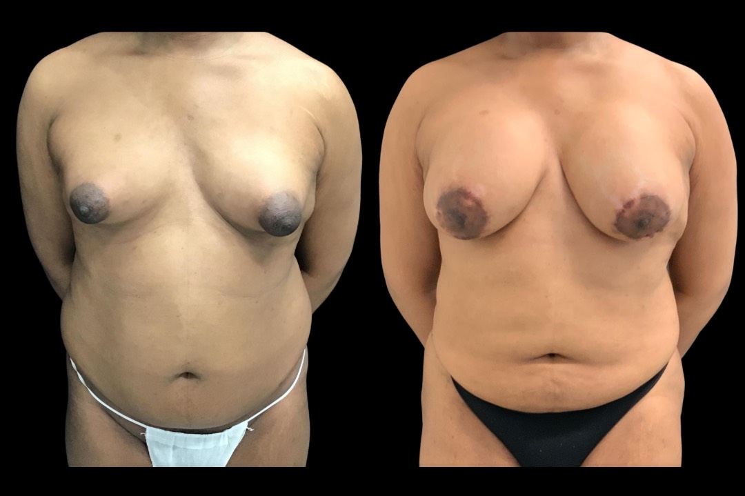 LipoBBL_33666_emale_before&after – 1