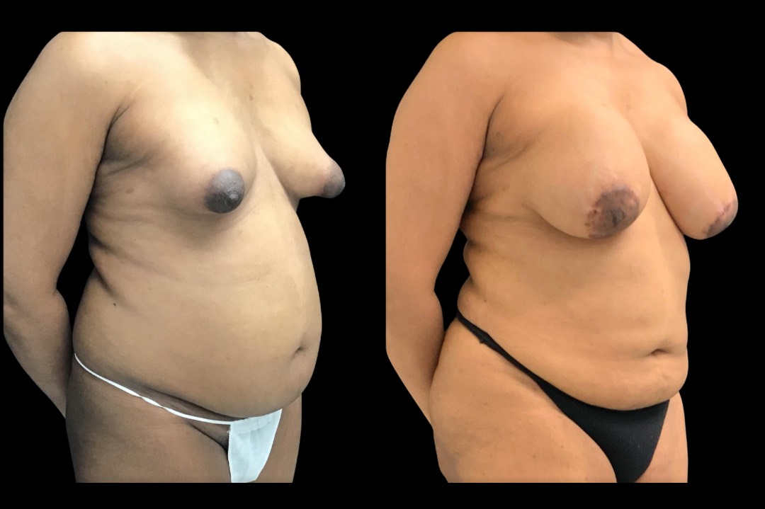 LipoBBL_33666_emale_before&after – 2