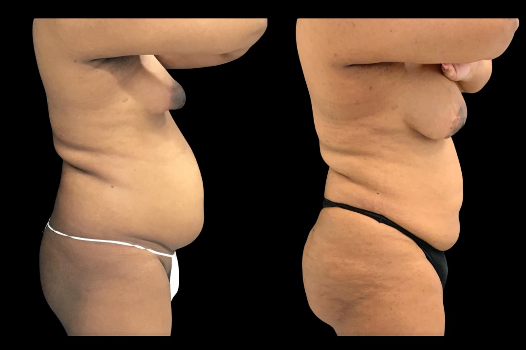 LipoBBL_33666_emale_before&after – 3