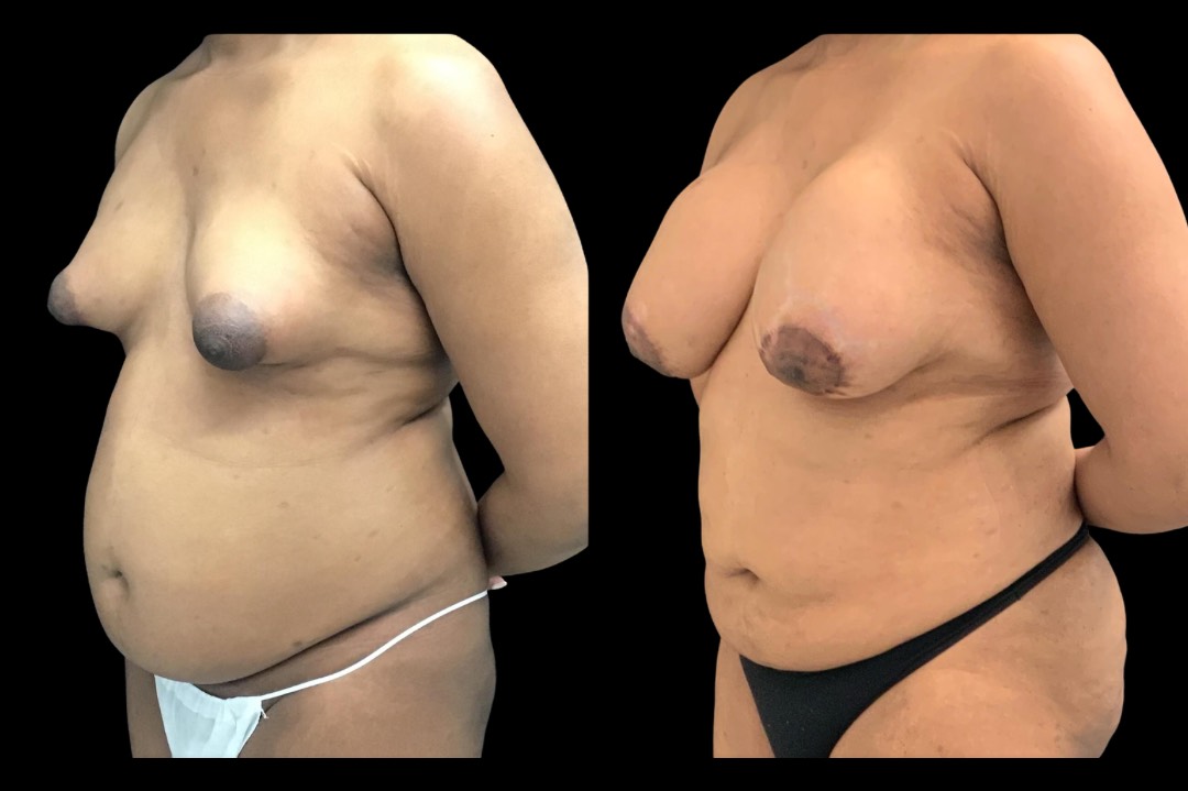 LipoBBL_33666_emale_before&after – 4