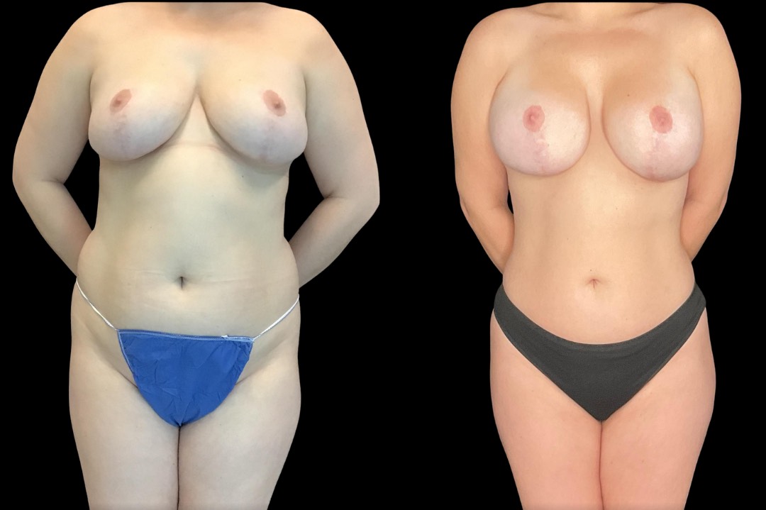 Lipo_29188_female_before&after – 1