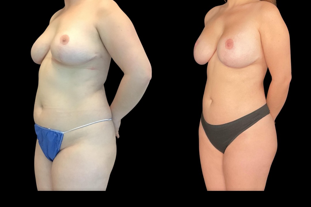 Lipo_29188_female_before&after – 2