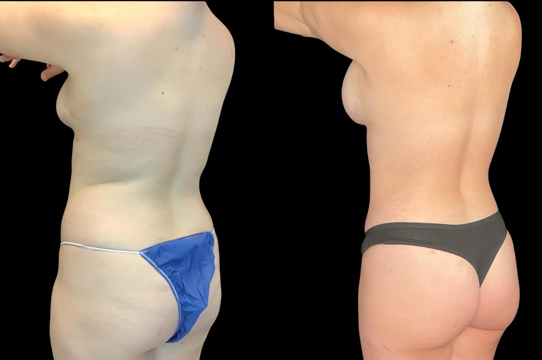 Lipo_29188_female_before&after – 3
