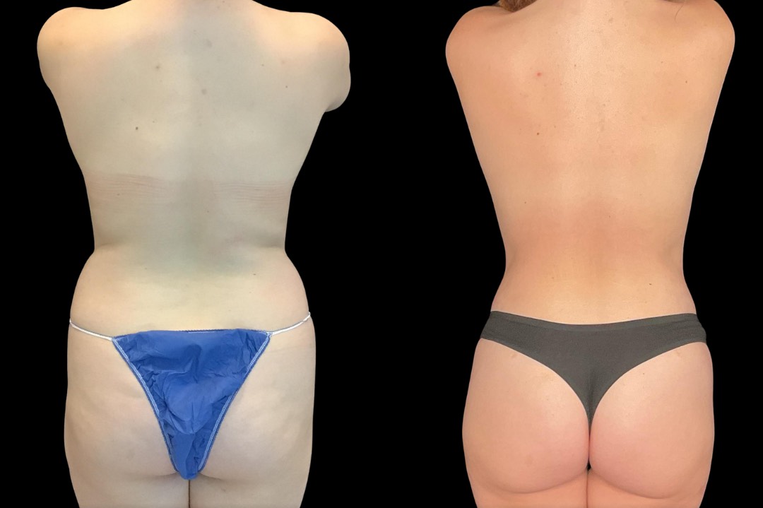 Lipo_29188_female_before&after – 4