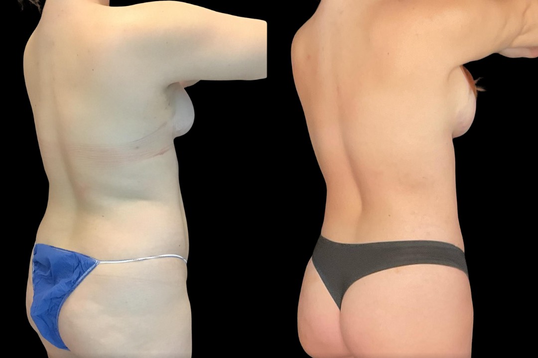 Lipo_29188_female_before&after – 5