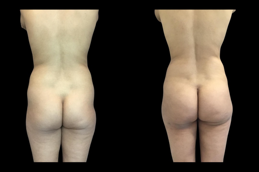 Lipo_female_before&after – 2