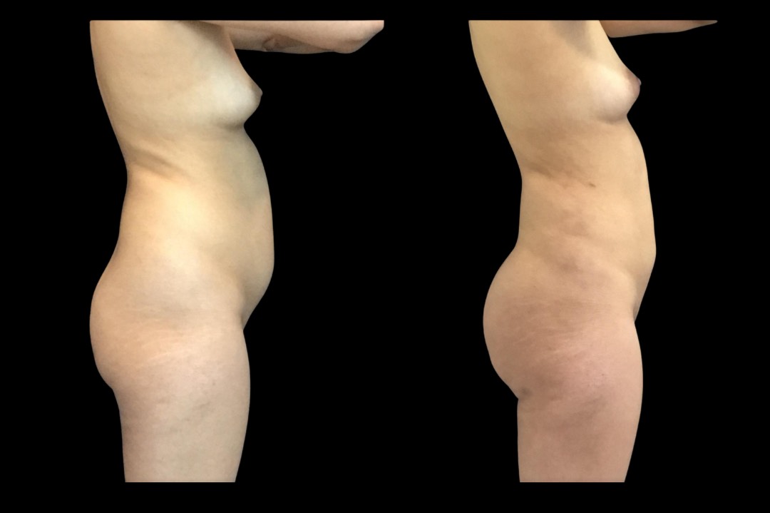 Lipo_female_before&after – 3