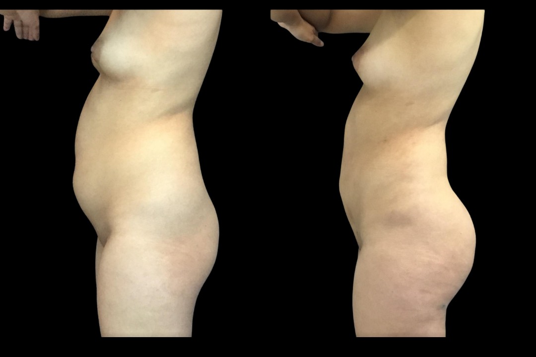 Lipo_female_before&after – 4