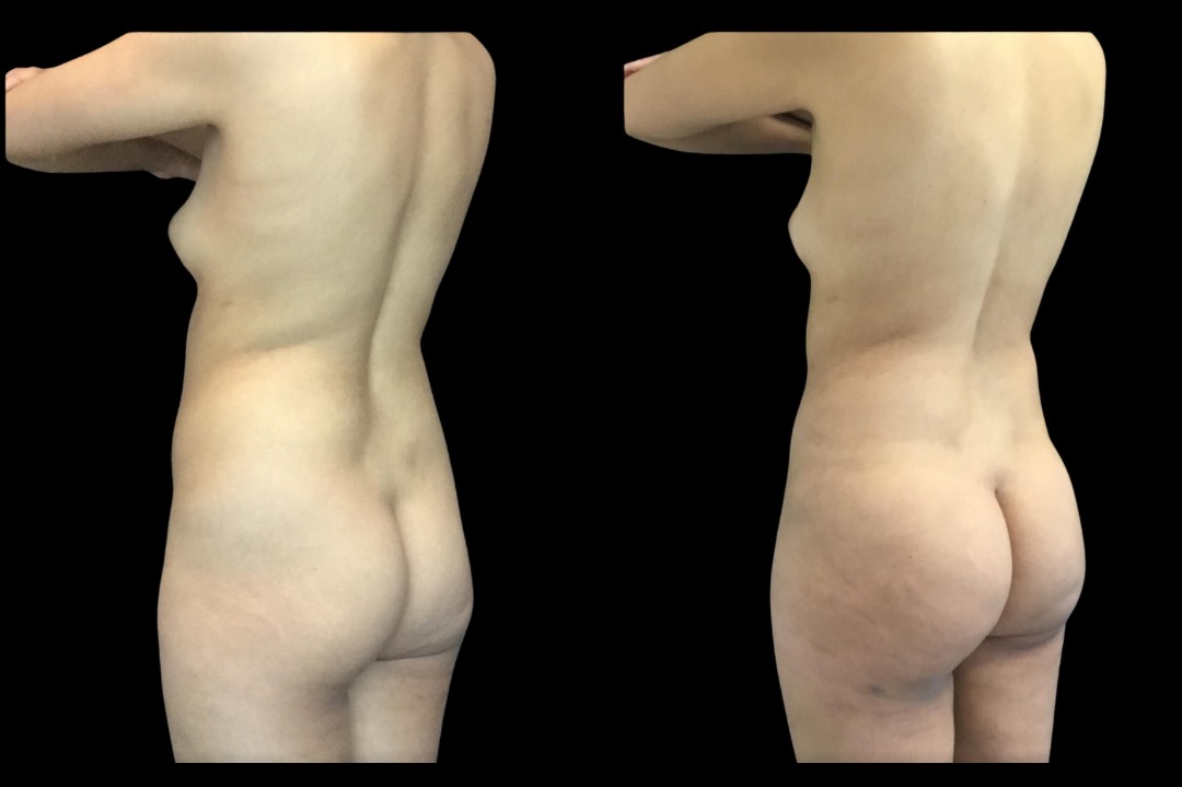 Lipo_female_before&after – 5