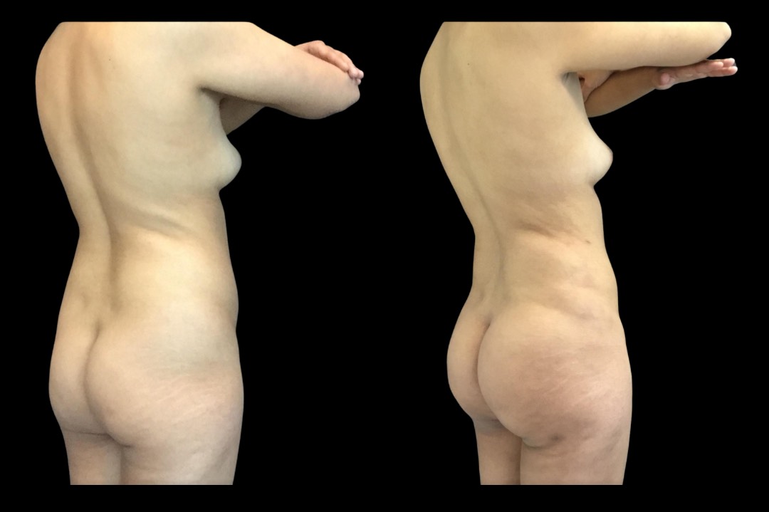 Lipo_female_before&after – 6