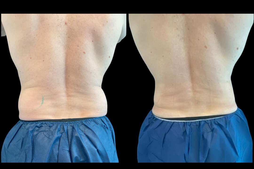 coolsculpt_male_before&after – 3