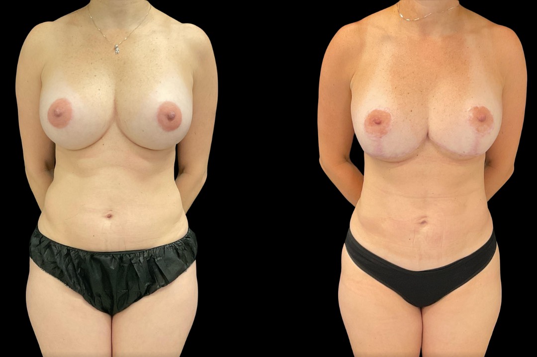 _lipo35922_female_before&after – 1