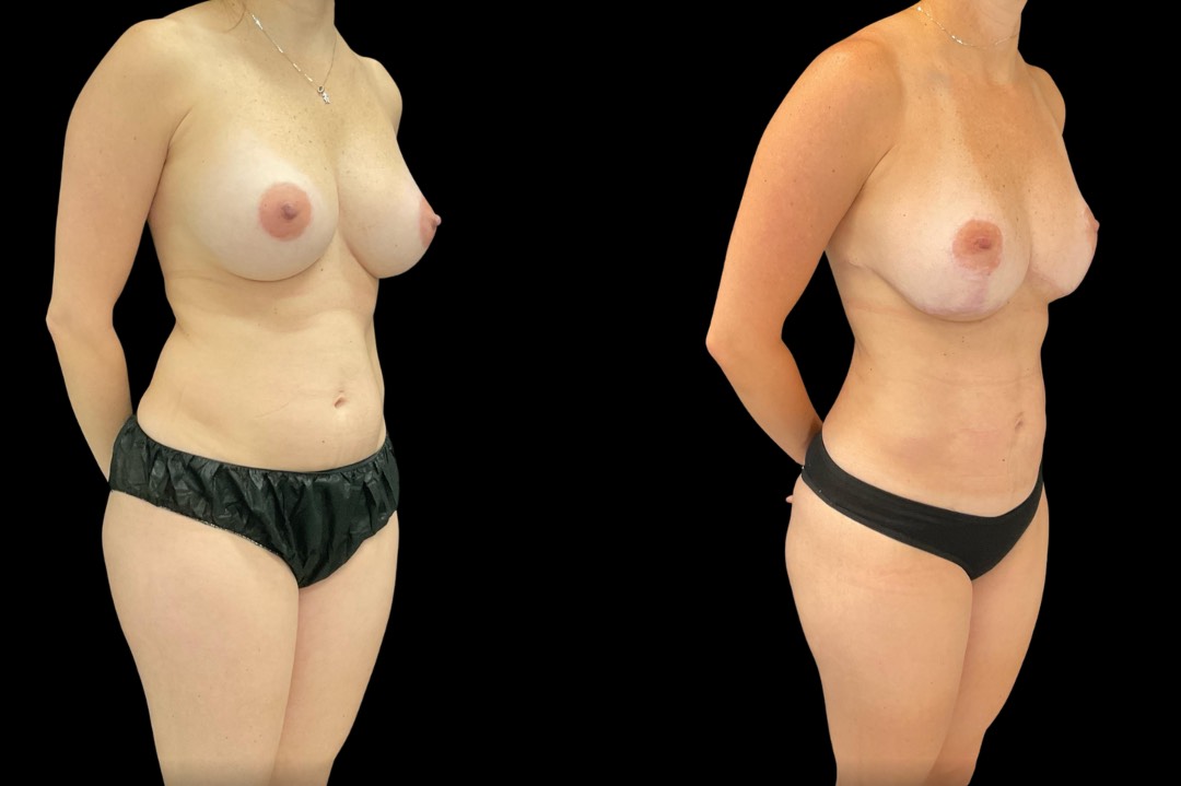 _lipo35922_female_before&after – 2