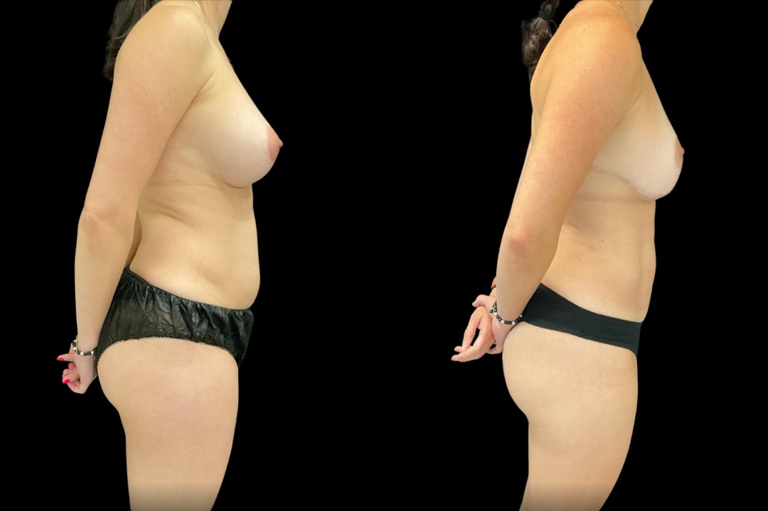 _lipo35922_female_before&after – 3