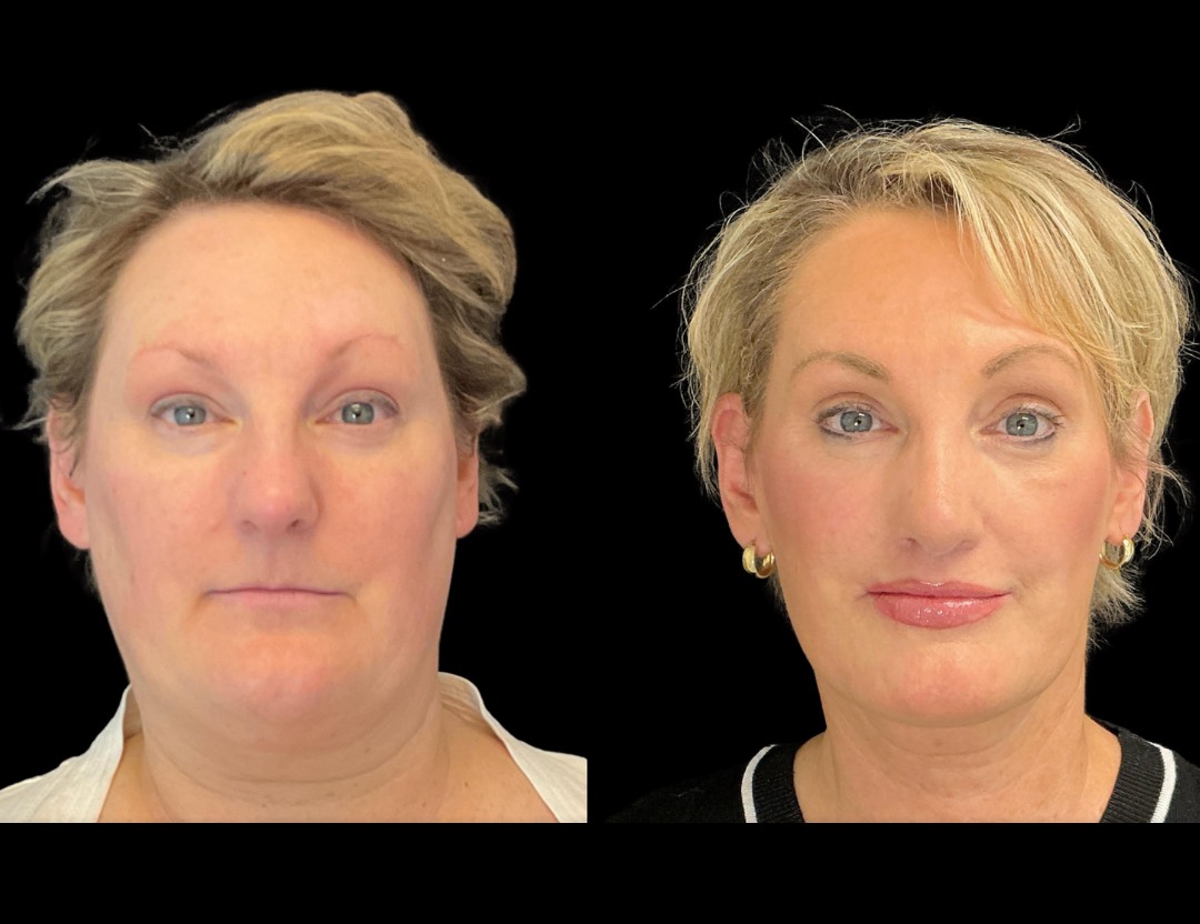 35001 facelift female before and after – 1