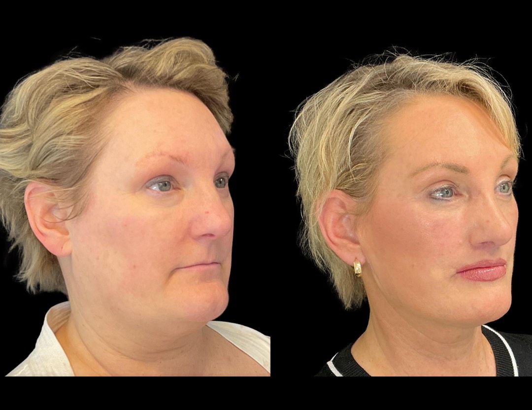 35001 facelift female before and after – 2