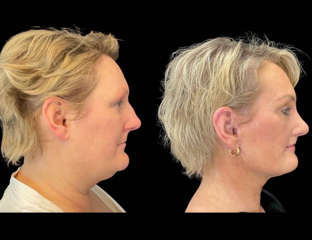 35001 facelift female before and after – 3