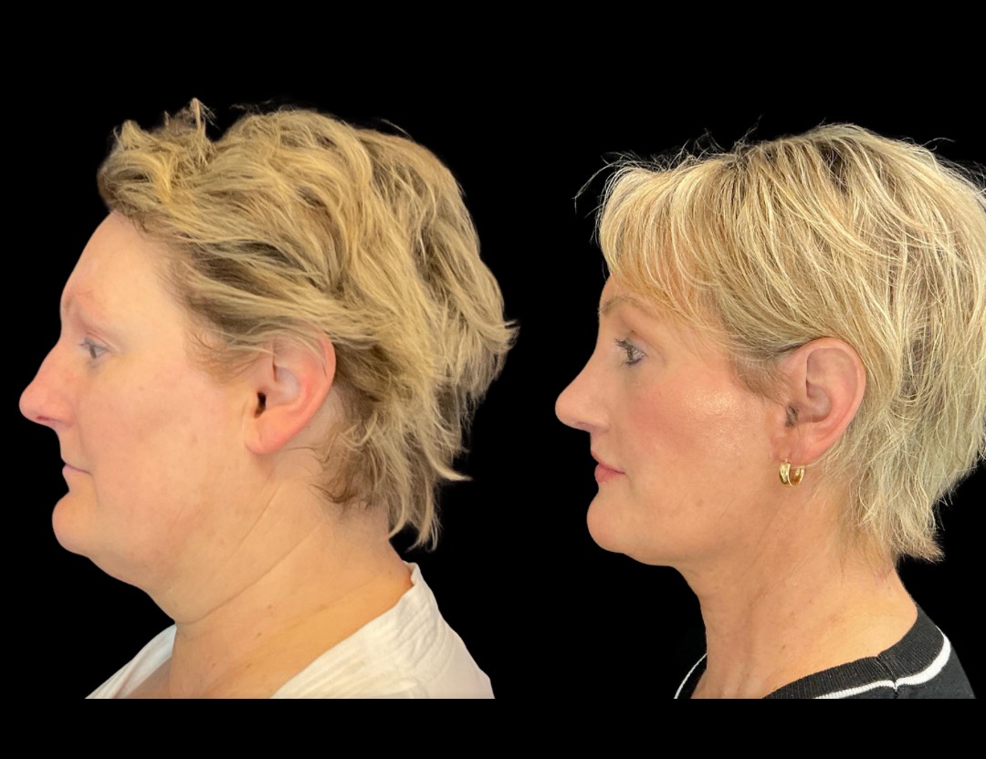 35001 facelift female before and after – 4