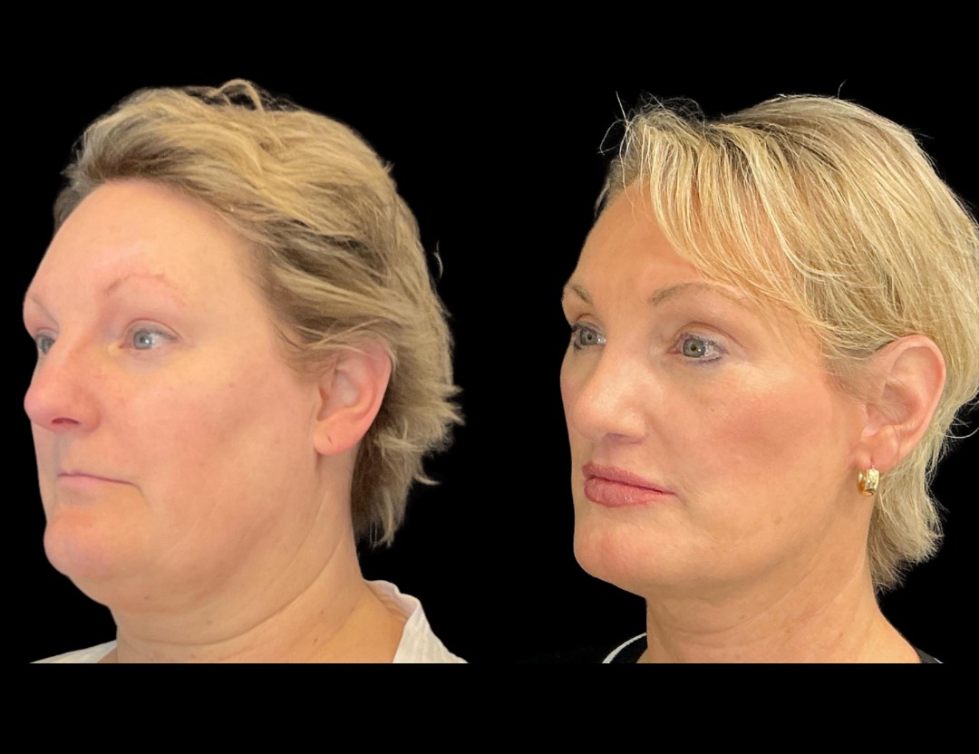 35001 facelift female before and after – 5