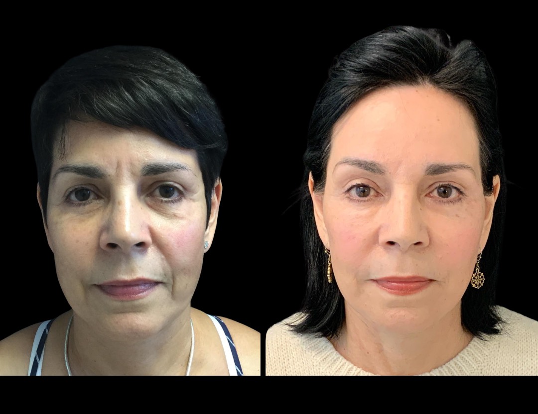 30356 facelift female before and after – 1