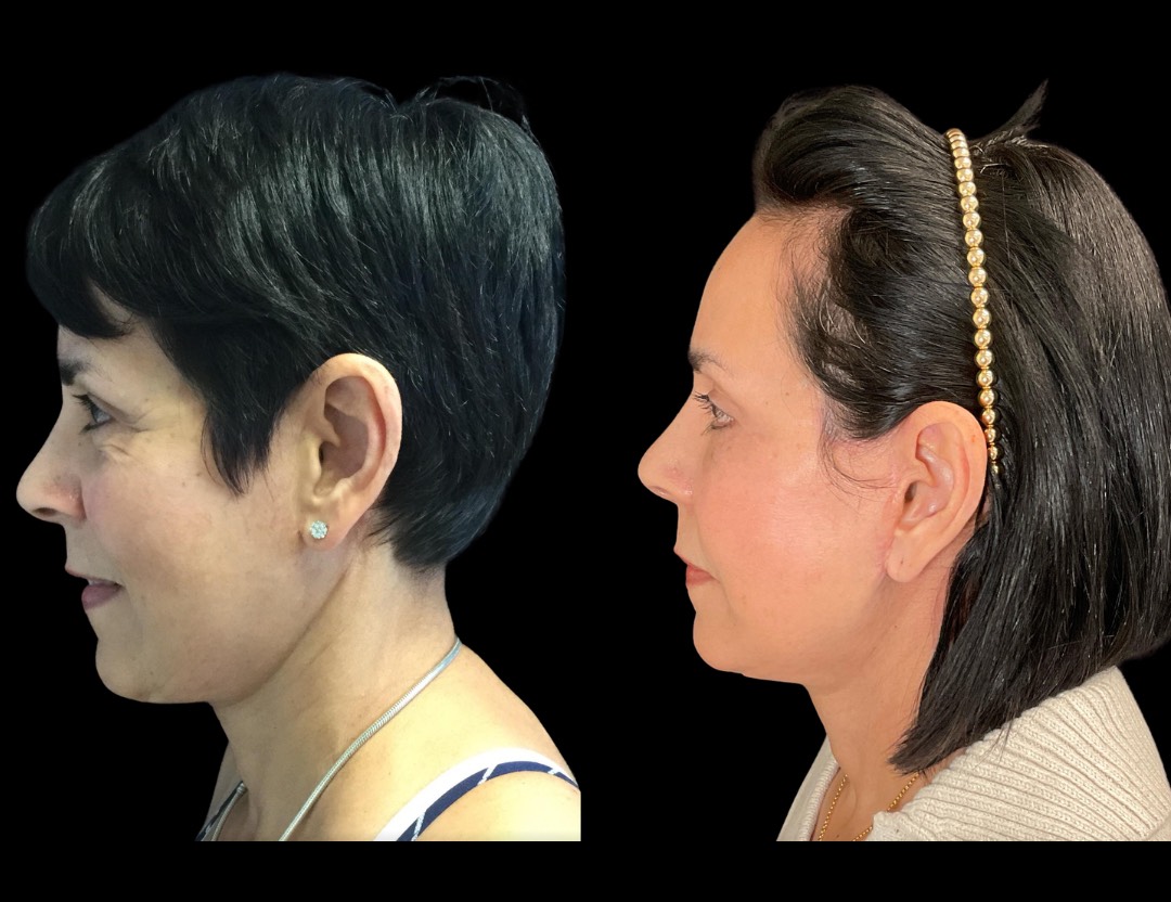 30356 facelift female before and after – 2