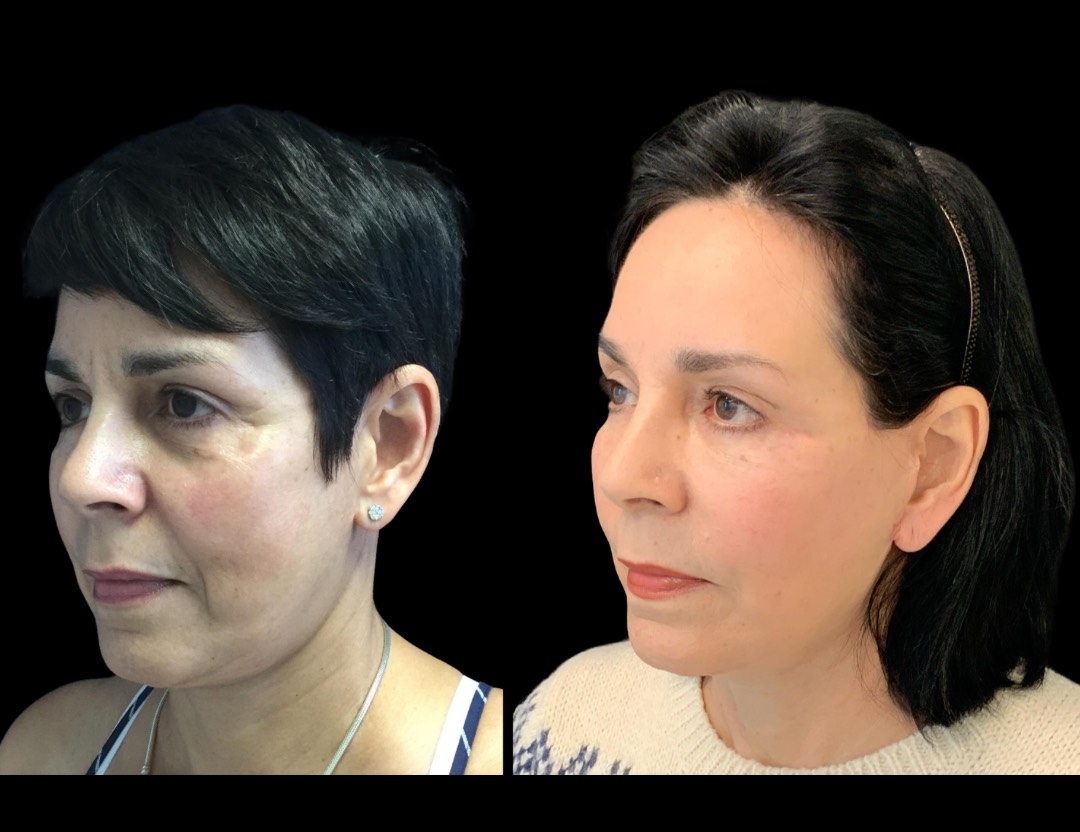 30356 facelift female before and after – 3