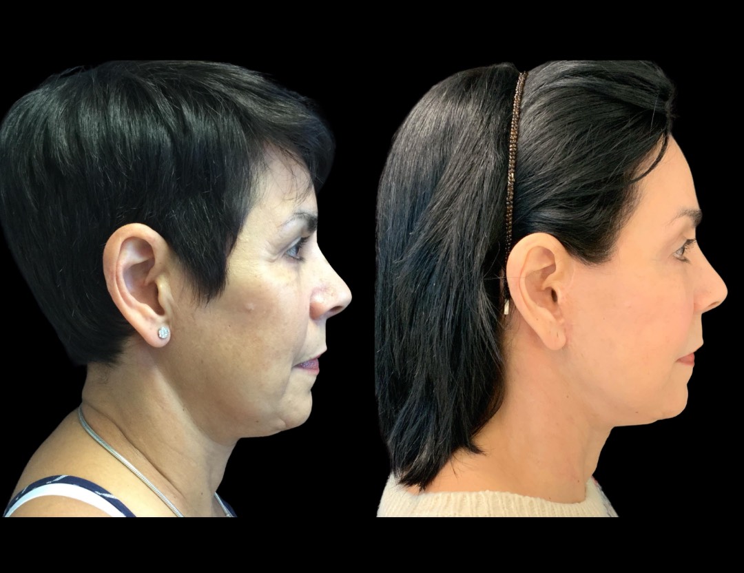 30356 facelift female before and after – 4