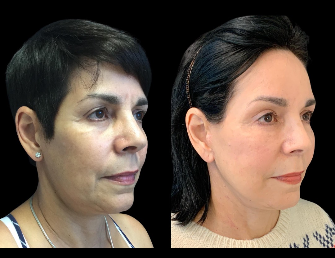 30356 facelift female before and after – 5