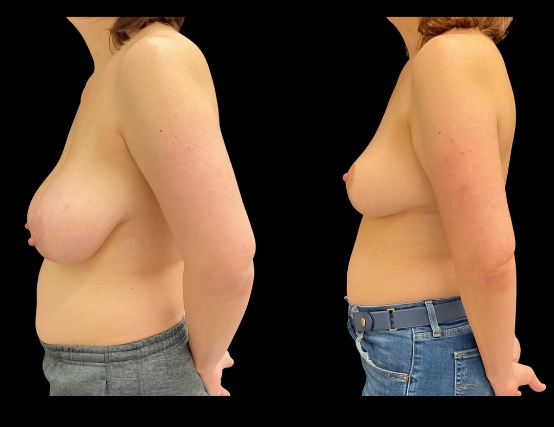 36472 breast reduction female before and after – 2