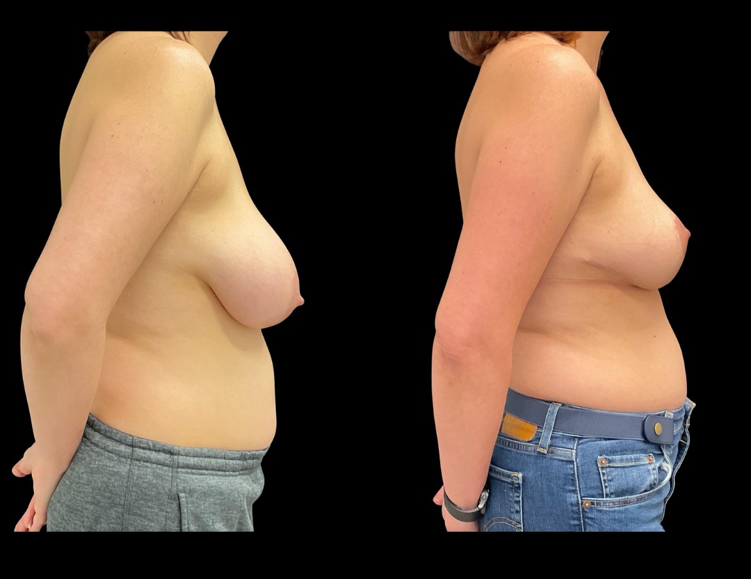 36472 breast reduction female before and after – 4
