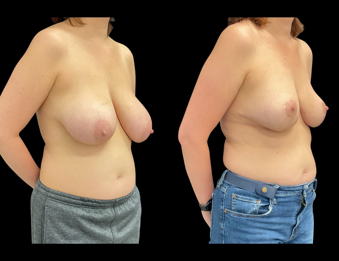 36472 breast reduction female before and after – 5