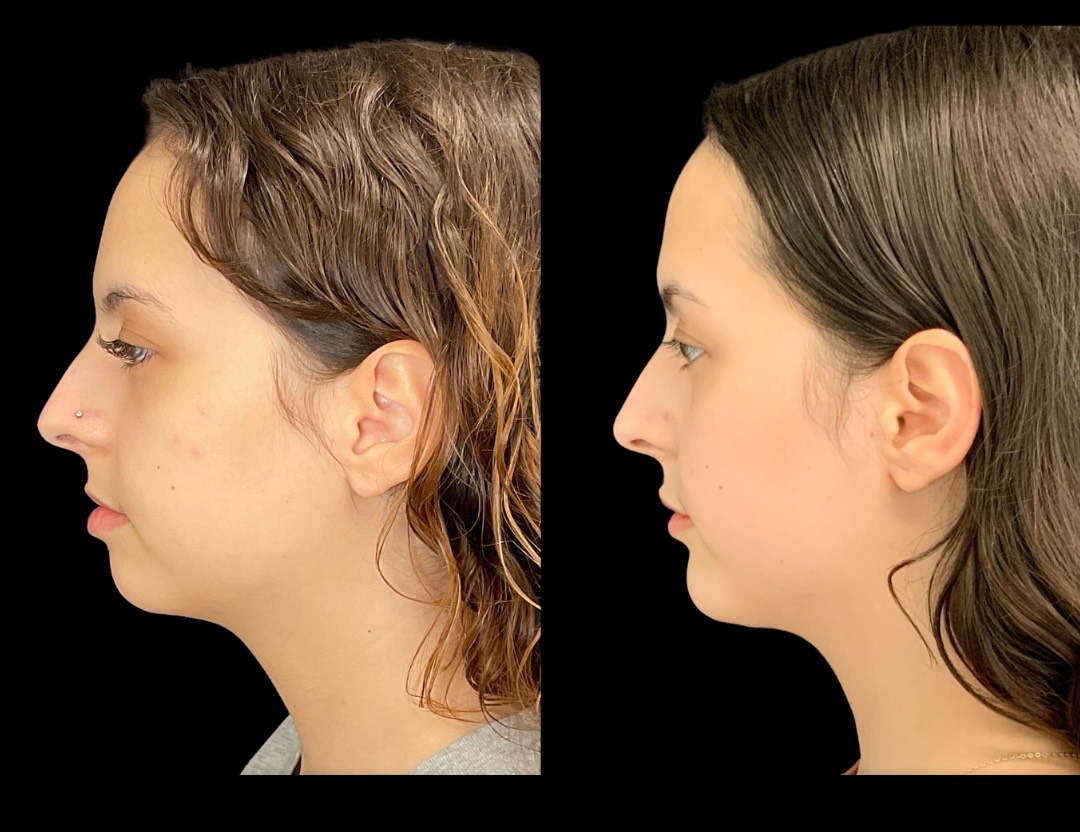 37562 chin implant female before and after – 2