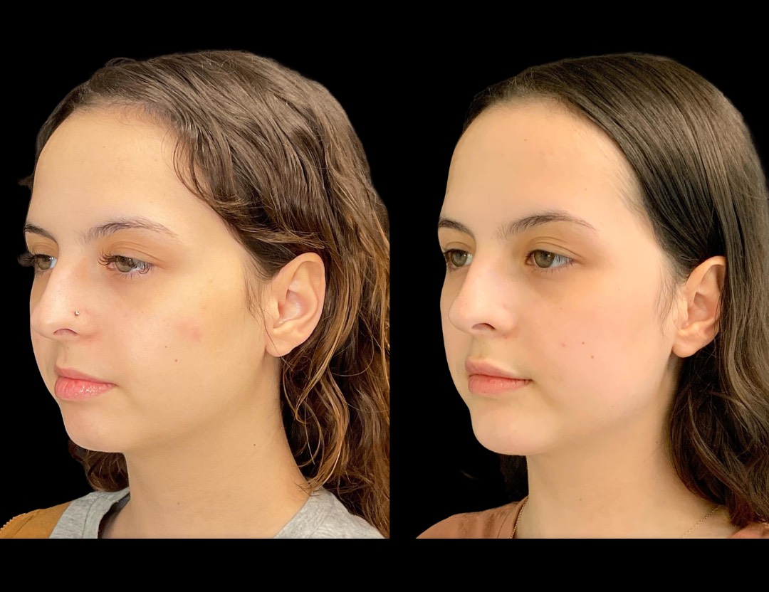 37562 chin implant female before and after – 3