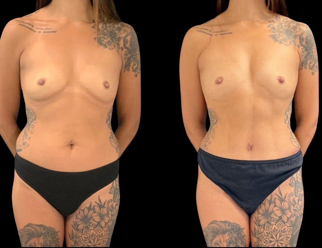 37761 tummy tuck female before and after – 1