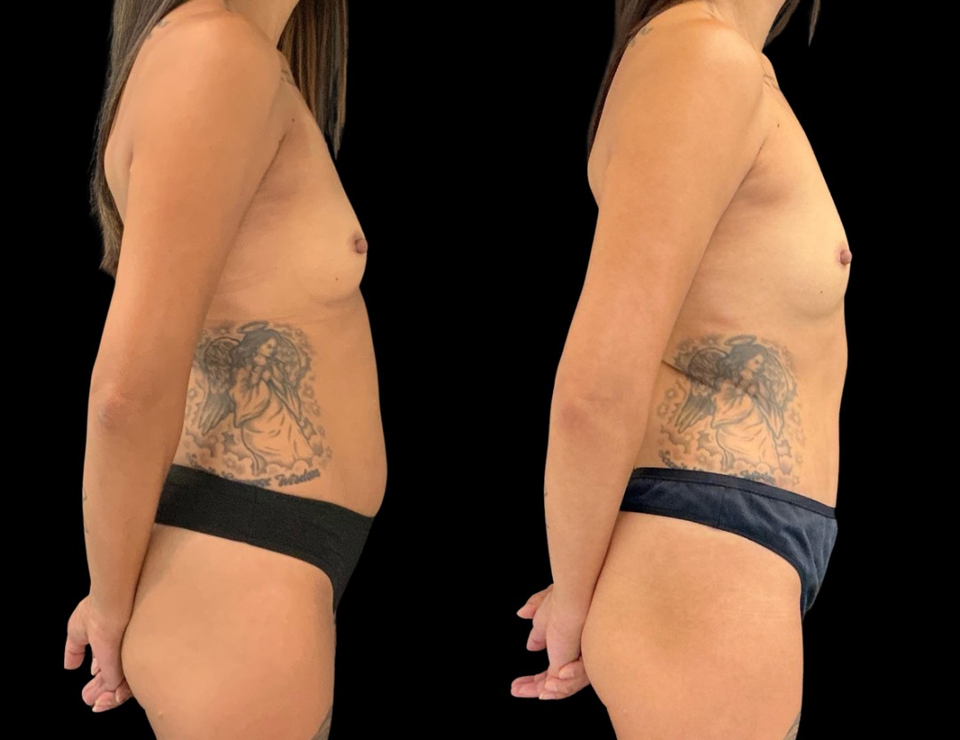 37761 tummy tuck female before and after – 3
