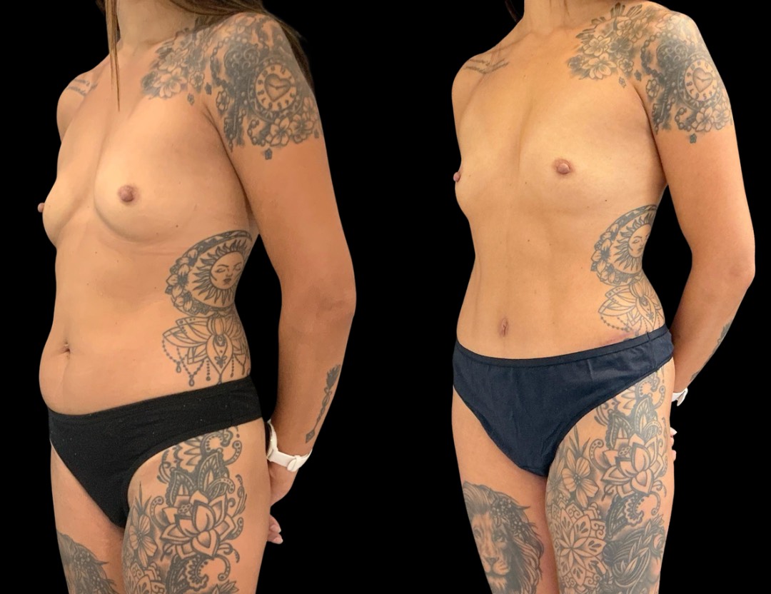 37761 tummy tuck female before and after – 5