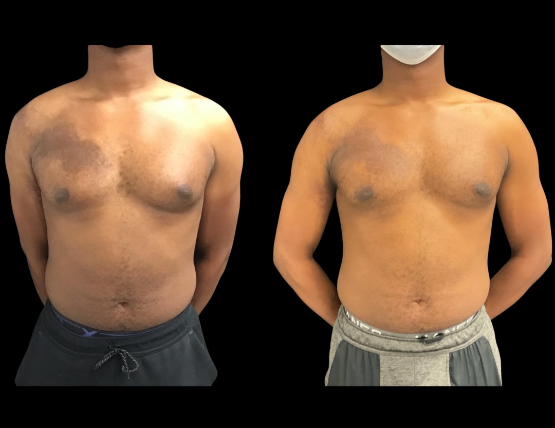 Copy of 19604 TT BA female before and after – 1