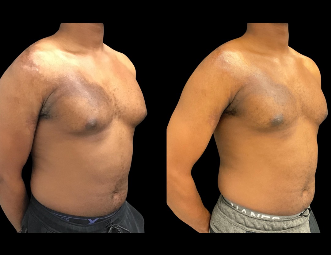 Copy of 19604 TT BA female before and after – 2