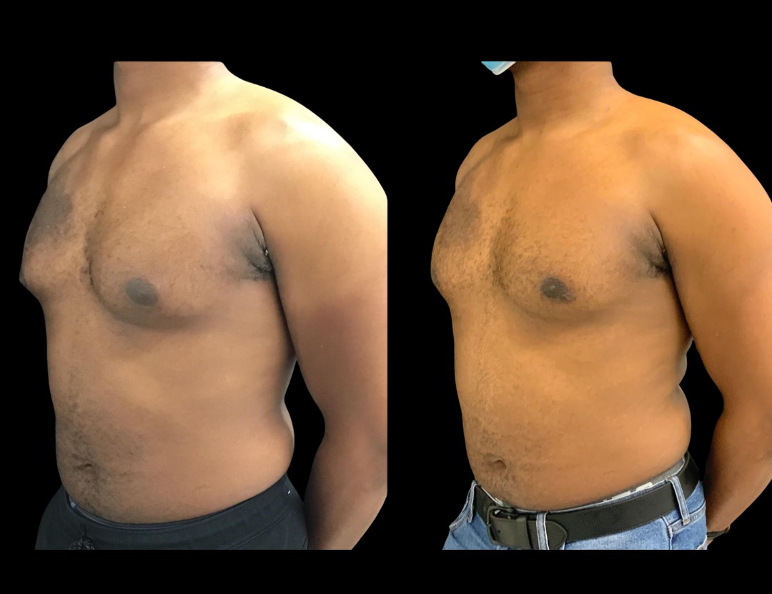 Copy of 19604 TT BA female before and after – 3