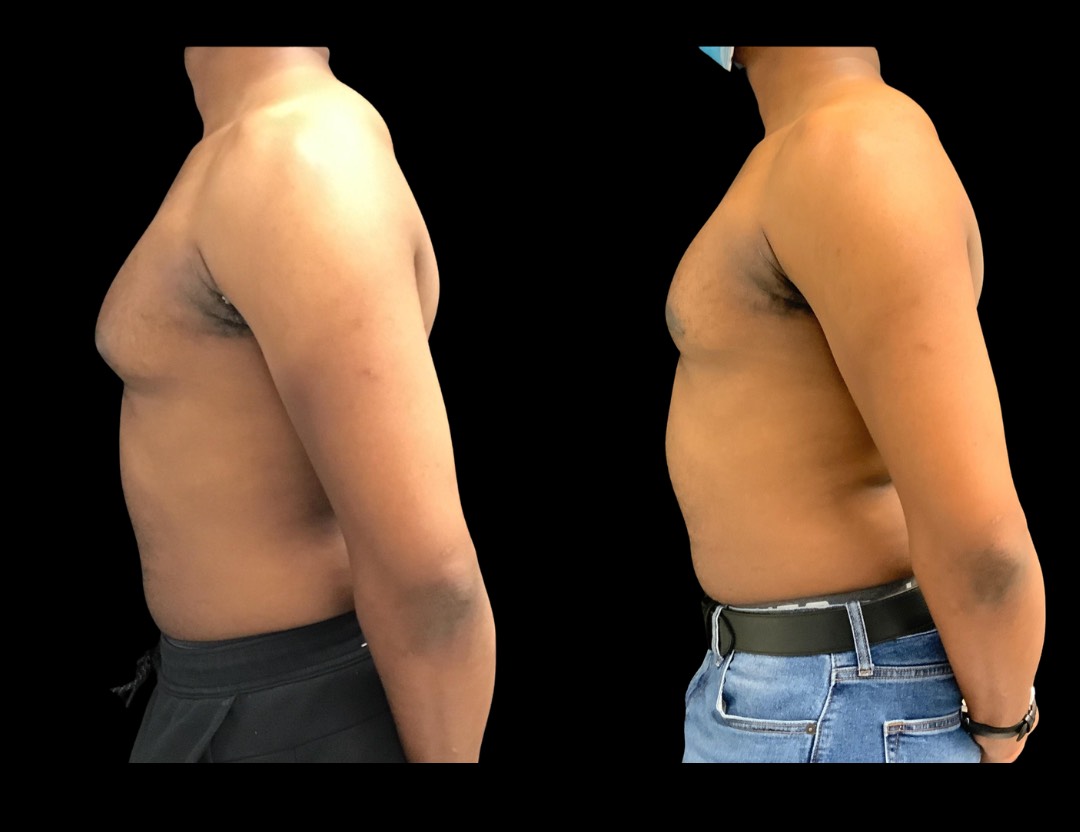 Copy of 19604 TT BA female before and after – 4