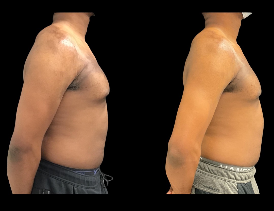 Copy of 19604 TT BA female before and after – 5