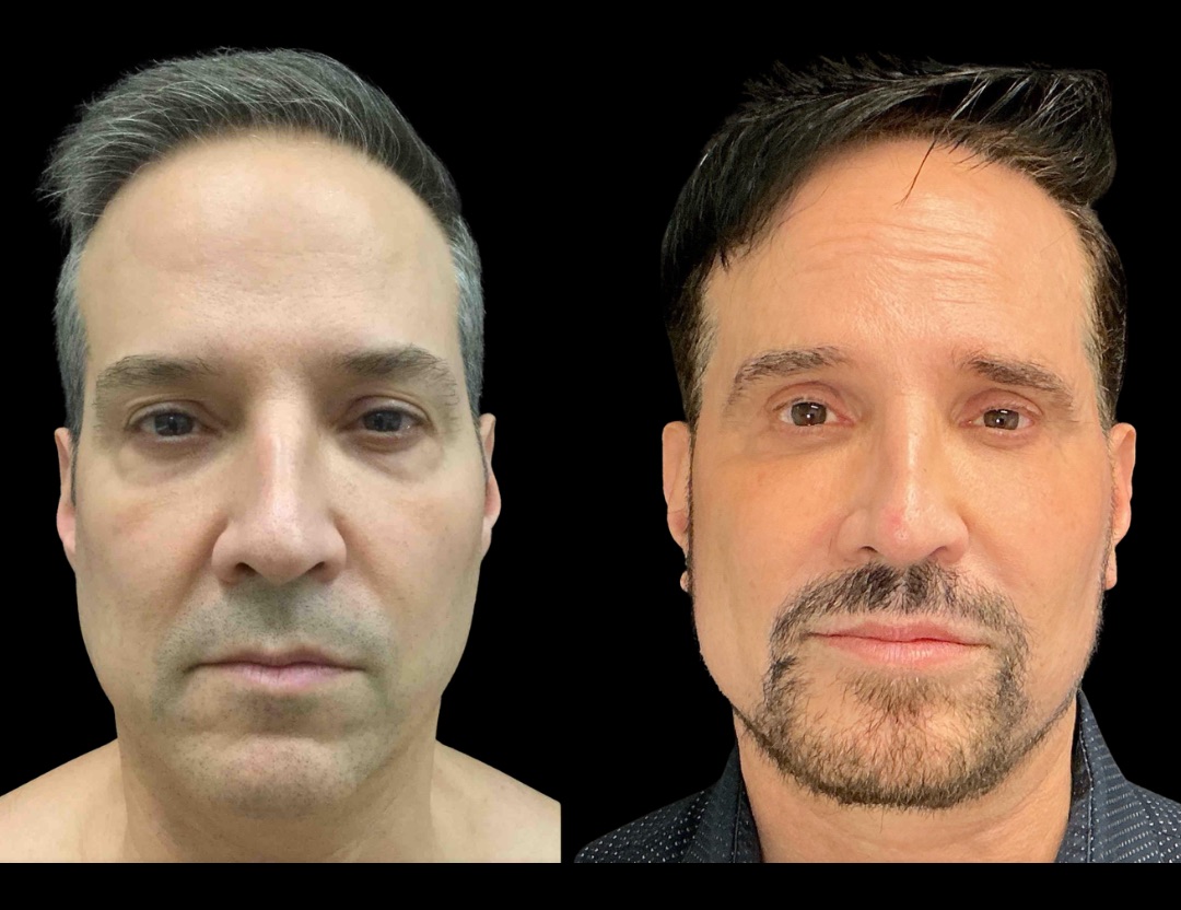 Copy of 37761 tummy tuck female before and after – 1