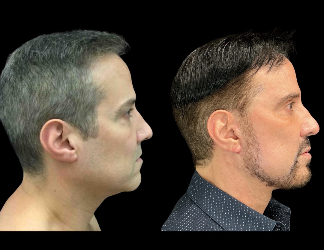 Copy of 37761 tummy tuck female before and after – 2