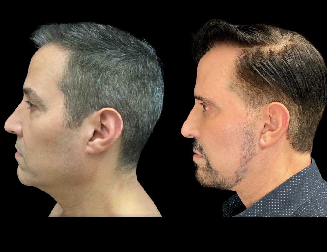 Copy of 37761 tummy tuck female before and after – 3